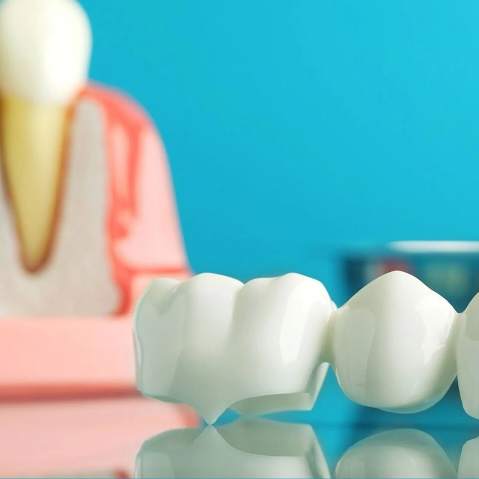 Illustrative photograph of a dental bridge restoration