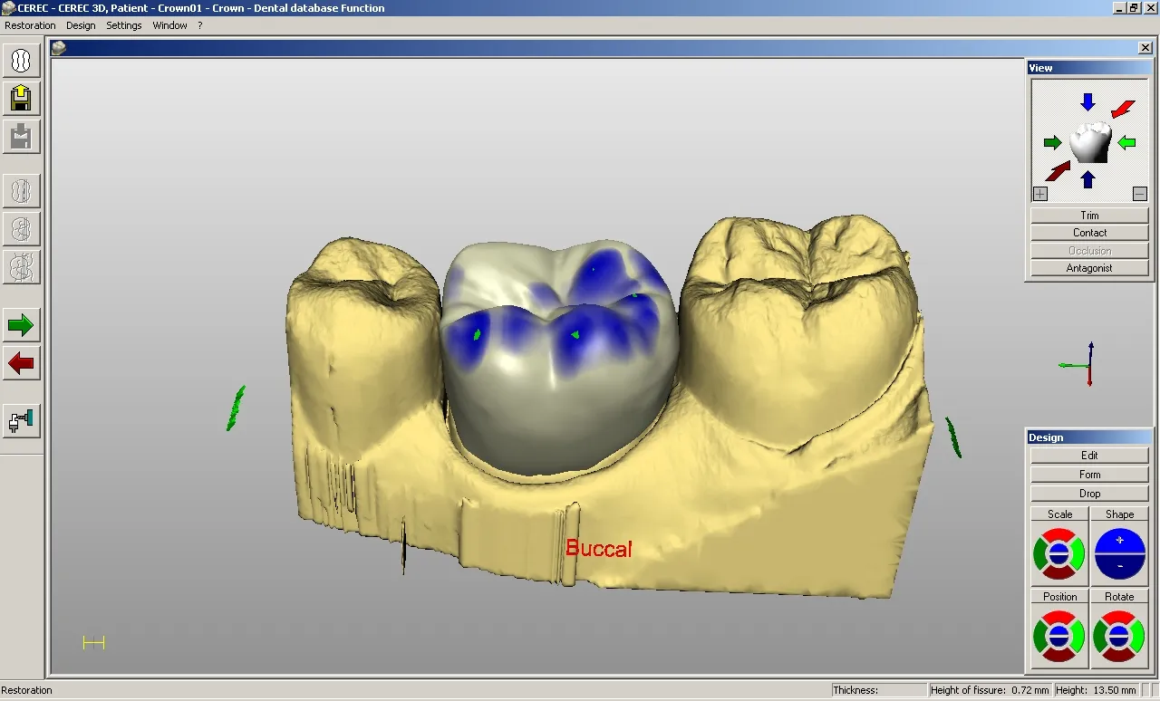 Crown restoration designed on a 3D tooth model in exocad CAD software
