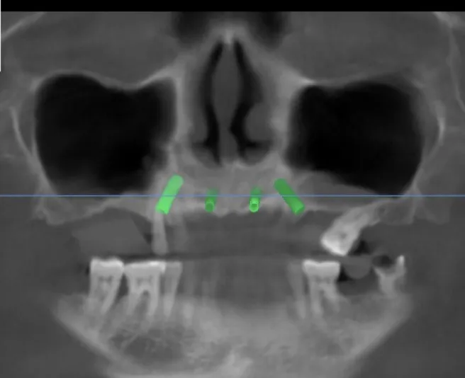CBCT position reference used during a full-arch implant planning workflow