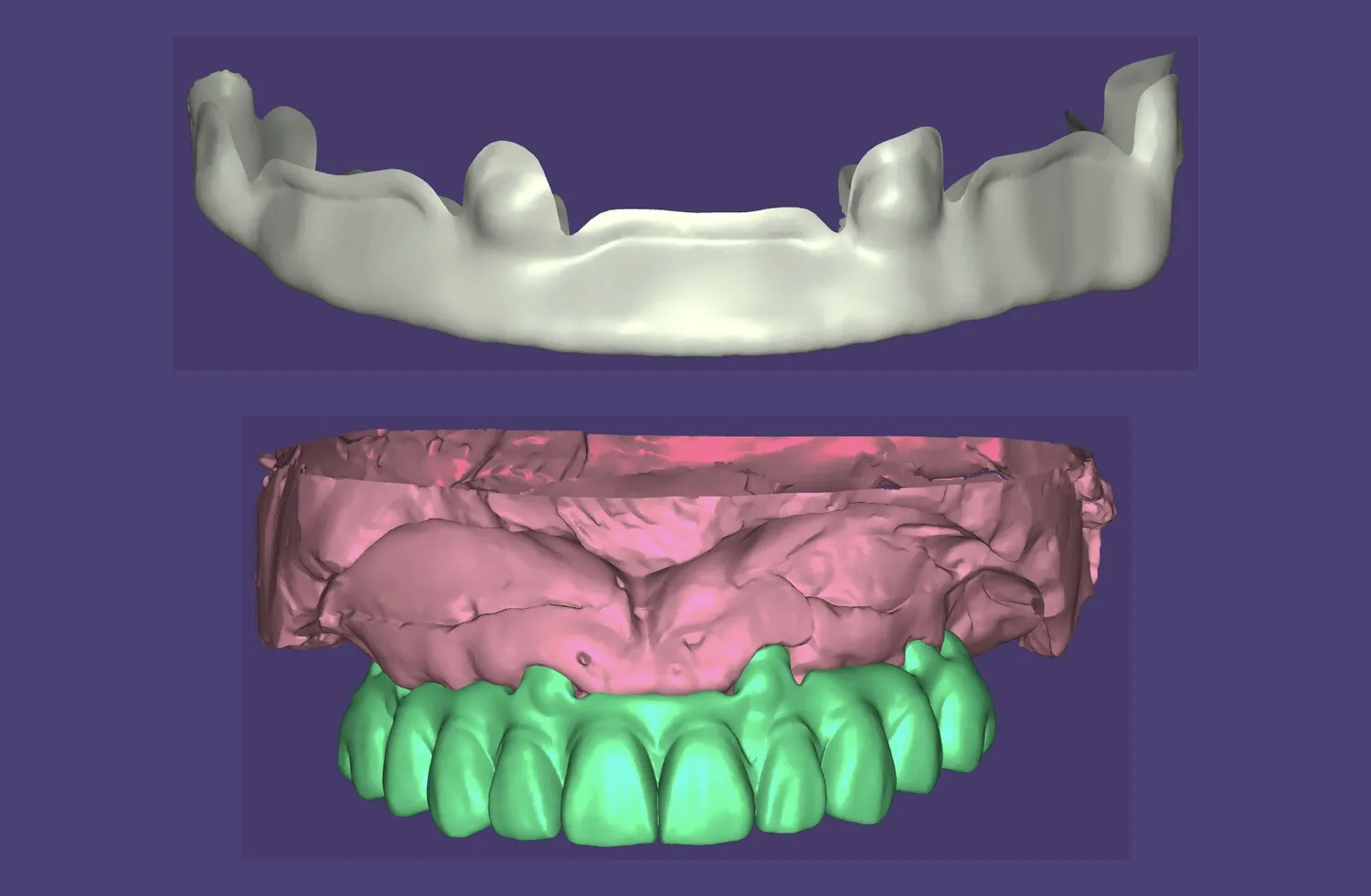Digital full-arch prosthetic planning showing the scan and proposed tooth position