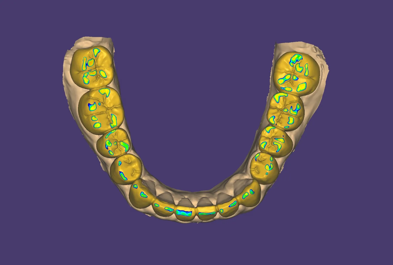 Illustrative CAD view of occlusal contacts on a designed dental arch