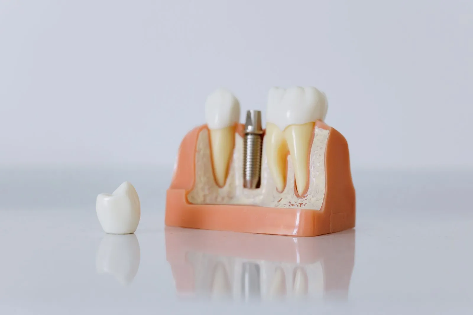 Illustrative stock photograph of an implant model with a separate crown